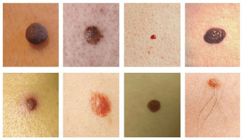 I più comuni macchie sulla pelle – è il neo e il papilloma virus (verruche)