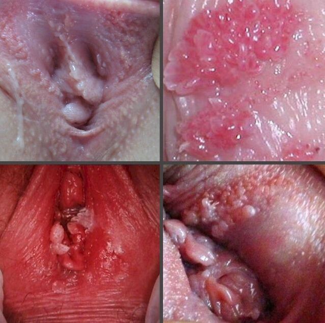 Primo piano dei papillomi nella vagina