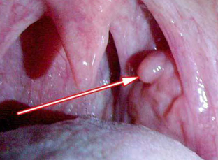Papilloma nella laringe
