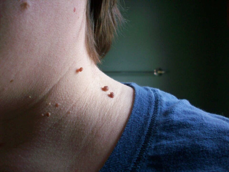 papillomi sul collo come trattare